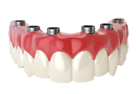 Full Arch Dental Implants