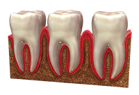 Gum disease treatment