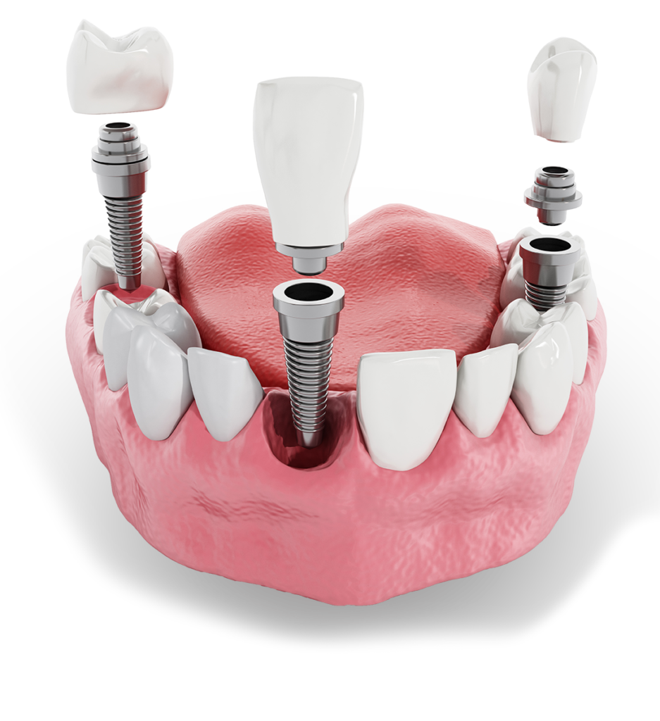 Full Arch Dental Implants Wantagh, NY Dr. Joo Kim